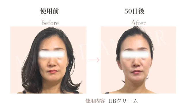UBクリーム ご使用事例│ホームケアによる変化の記録｜マン・ダムール