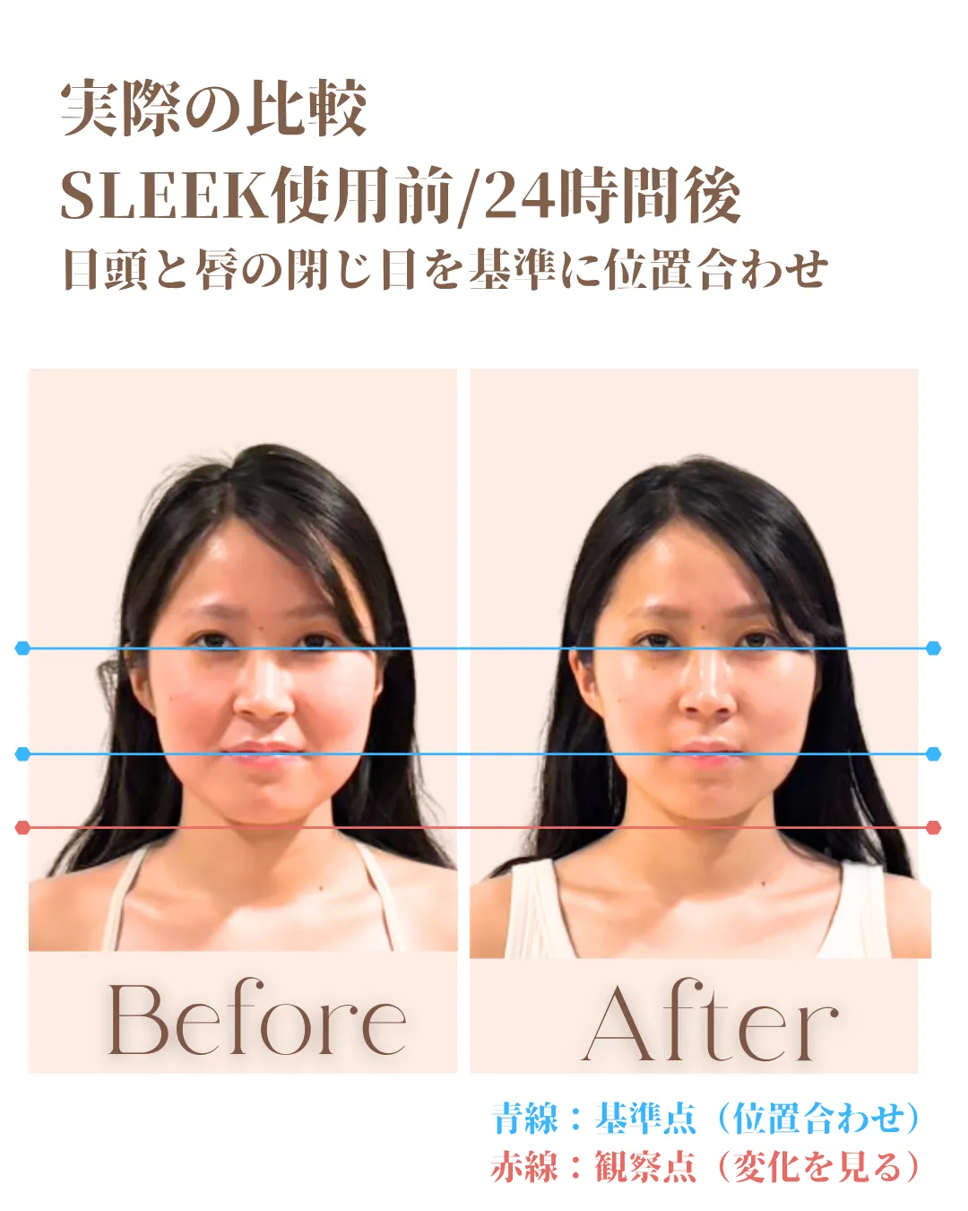 SLEEK使用前と24時間後を同じ基準点で位置合わせした比較画像